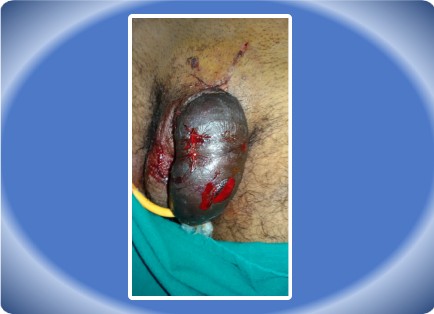 PENILE INJURY